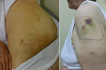 bruising at semaglutide injection site Bruising: A Neglected, Though Patient-Relevant Complication of Insulin Injections Coming to Light from a Real-Life Nationwide Survey