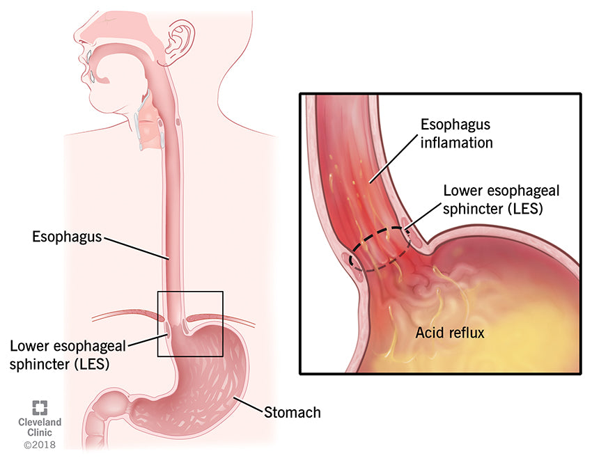 Acid Reflux & GERD: Symptoms, What It Is, Causes, Treatment