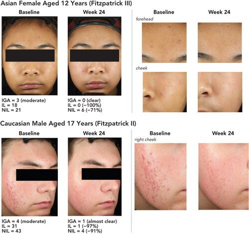 side effects of ghk-cu injections what are the potential Mitigating Injection Pain: Tips and Tricks GHK-Cu Peptides Before and After: –