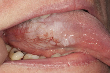 A case report of oral nicotine-associated keratosis and a review of oral  mucosal changes in tobacco and similar products
