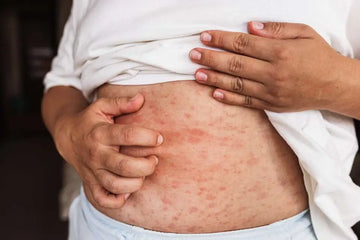 Tirzepatide & Zepbound Rash and Injection-Site Reactions: Causes, Treatment, and Prevention