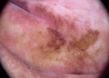 Dermoscopic and Clinical Features of Pigmented Skin Lesions of the Genital Area