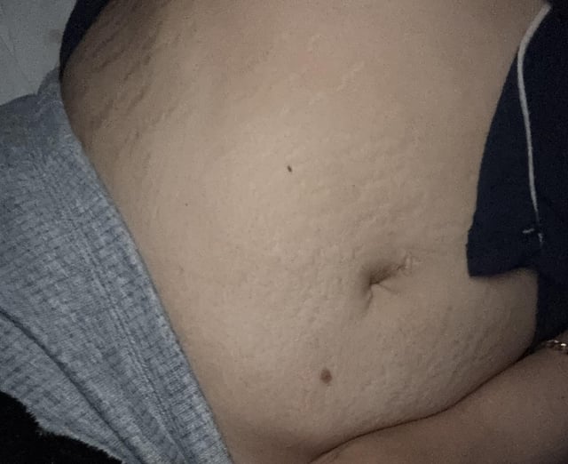 GHKCU & Stretch Marks : r/BodyHackGuide