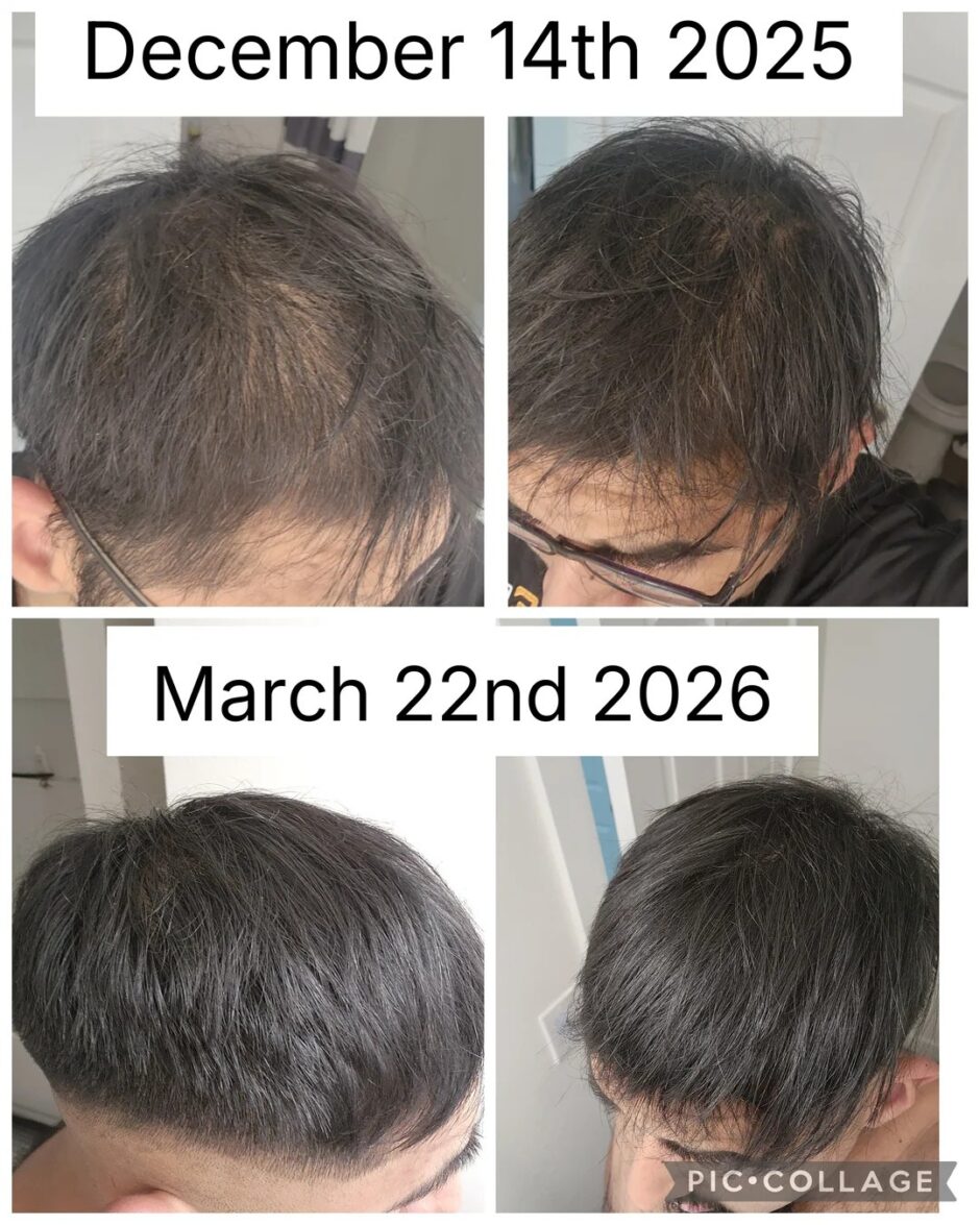 GHK-Cu Peptides Before and After: Dosage, Benefits & How It Works for Skin and Hair