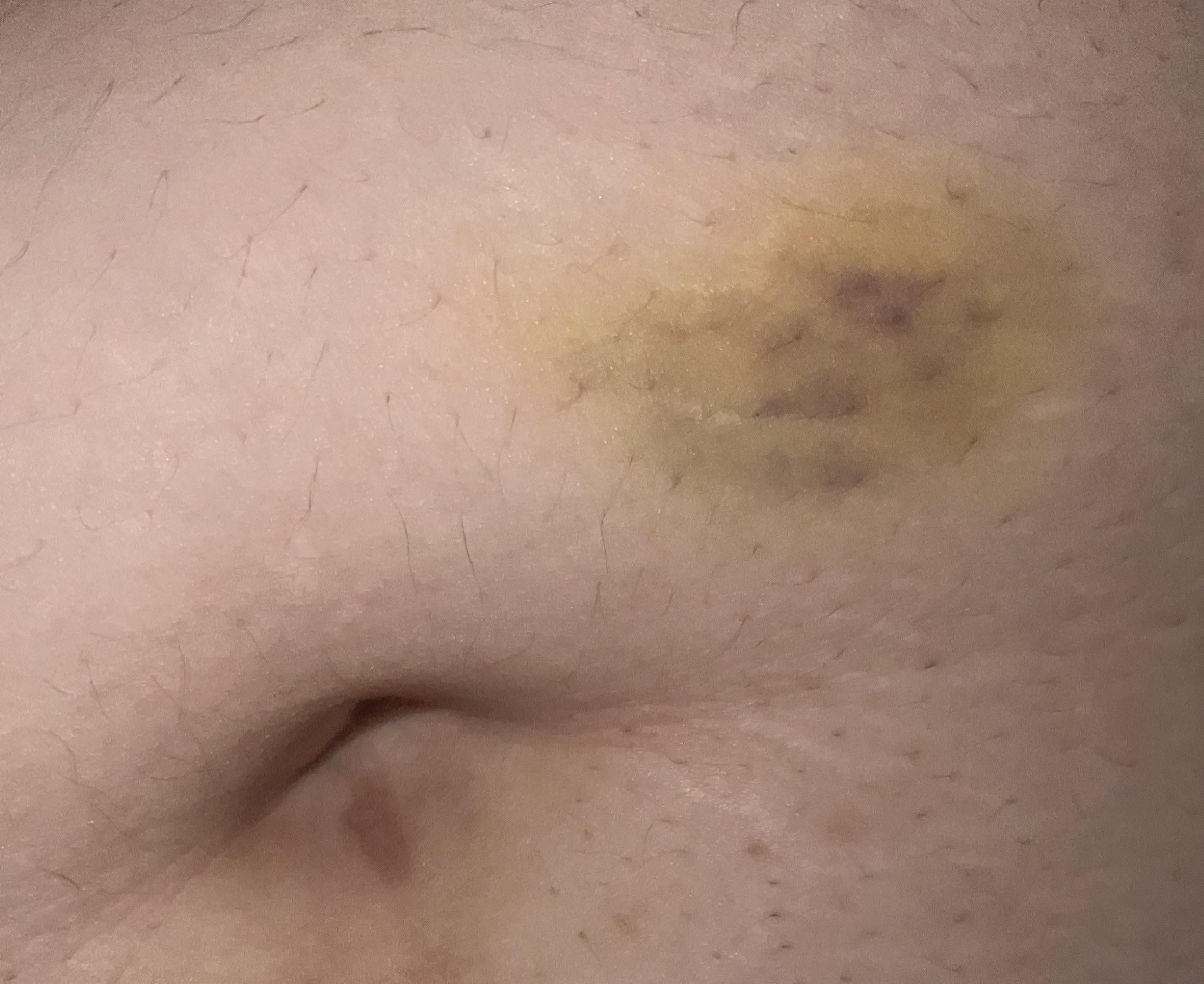 bruise at tirzepatide injection site Worried about intense bruising after first 5 dose shot : r/tirzepatidecompound Bruising After Semaglutide Shot: Causes, –
