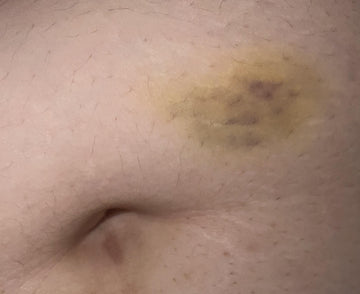bruise at tirzepatide injection site Worried about intense bruising after first 5 dose shot : r/tirzepatidecompound Bruising After Semaglutide Shot: Causes, –