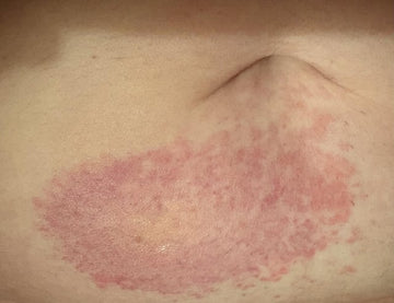 tirzepatide itchy skin tirzepatide itching all over body Not good news from Allergist : r/Zepbound