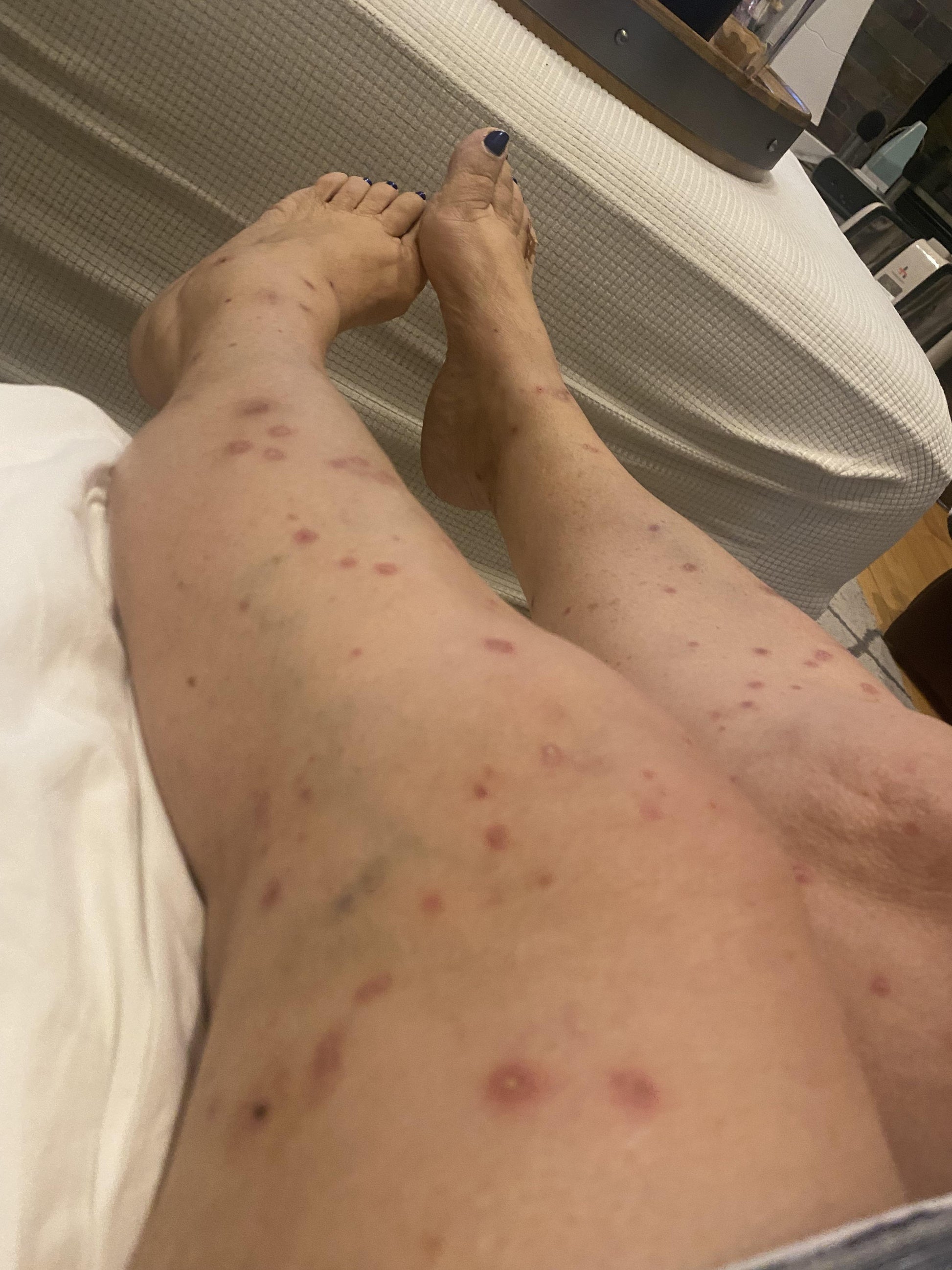 semaglutide skin rash Anyone else experiences hives/skin issues? : r/Ozempic Initial presentation of the patient –