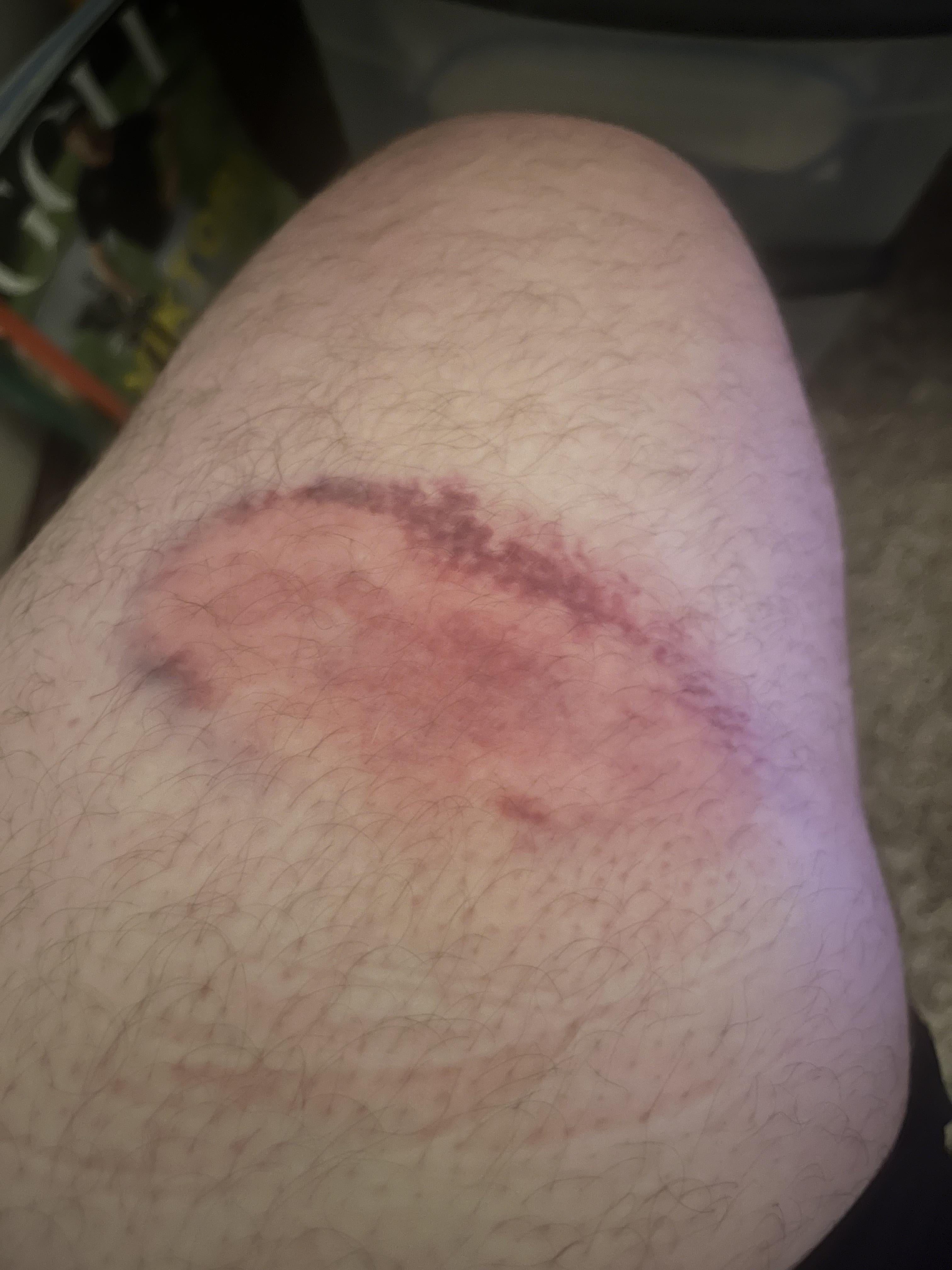 Injection site reactions